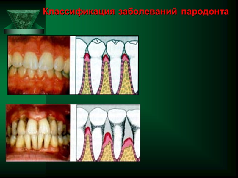 Классификация заболеваний пародонта